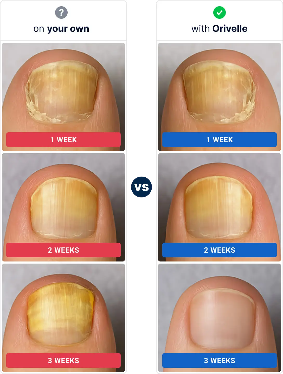 Sammenligning ubehandlet vs. Orivelle